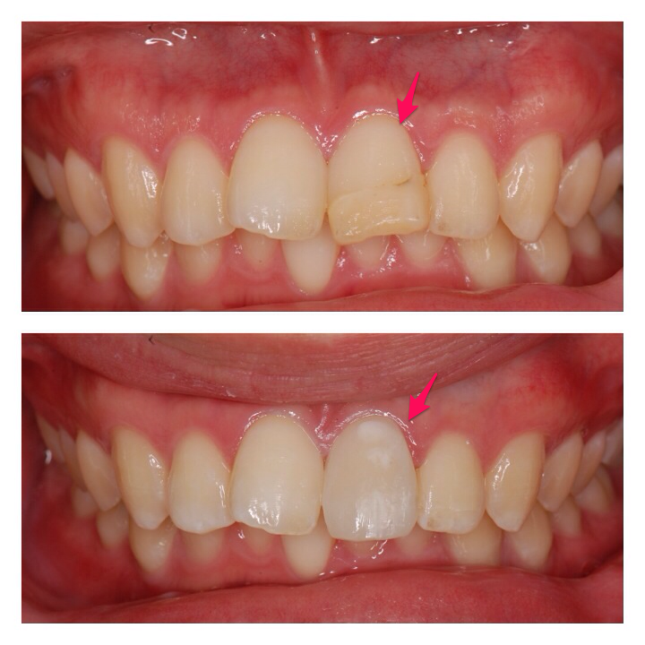 ダイレクトボンディング