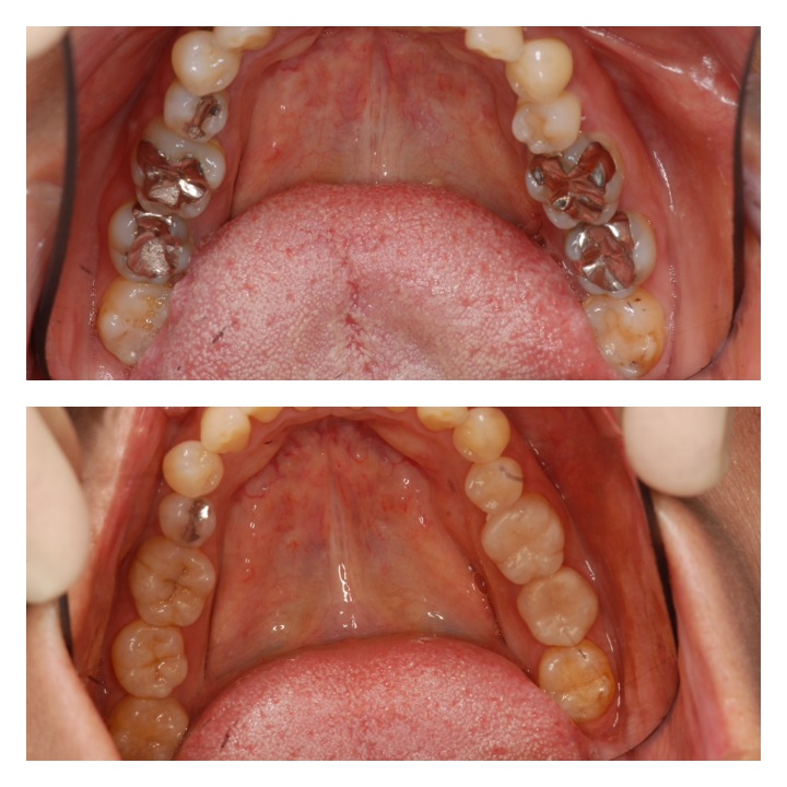 ダイレクトボンディング