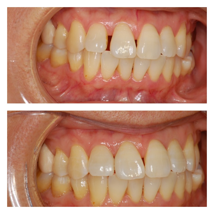 ダイレクトボンディング