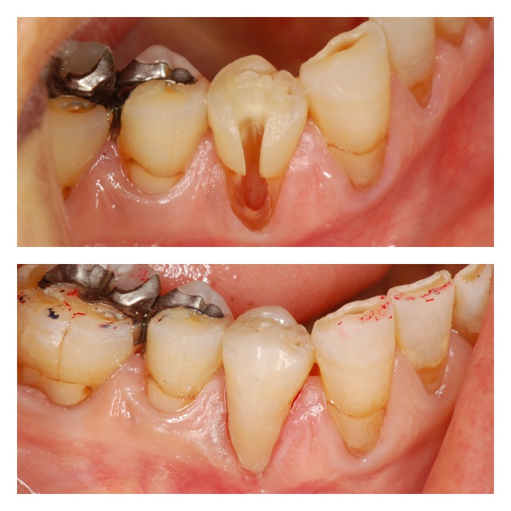 ダイレクトボンディング3