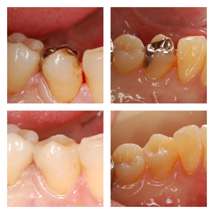 ダイレクトボンディング2