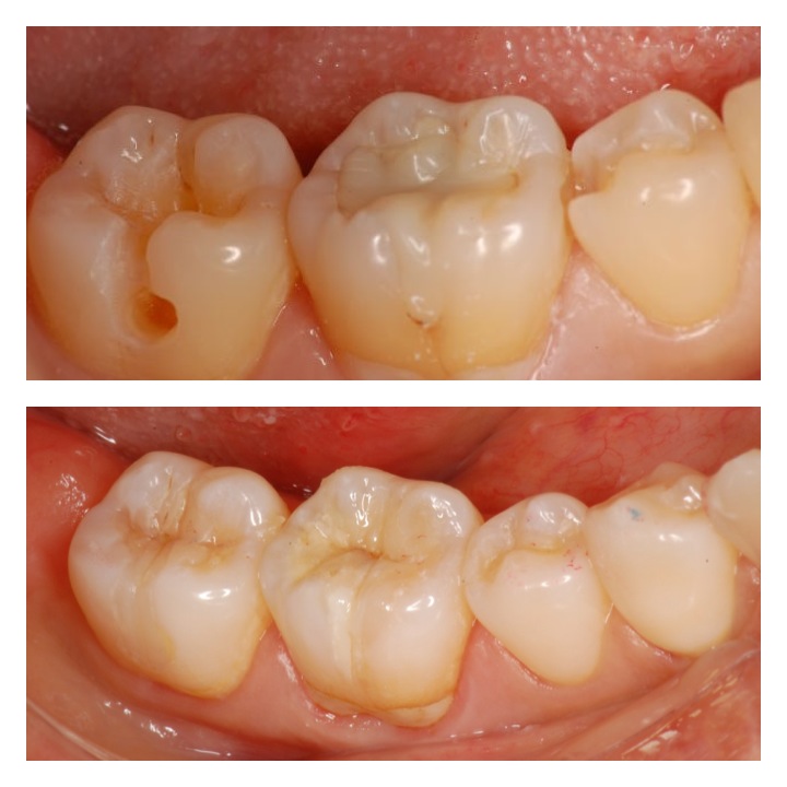 ダイレクトボンディング4