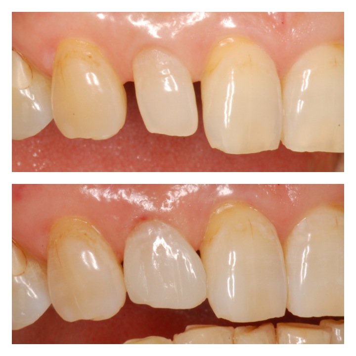 ダイレクトボンディング１