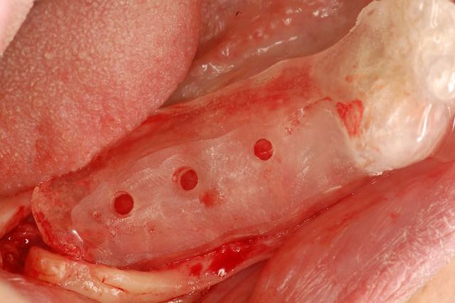 インプラント手術ステント設置