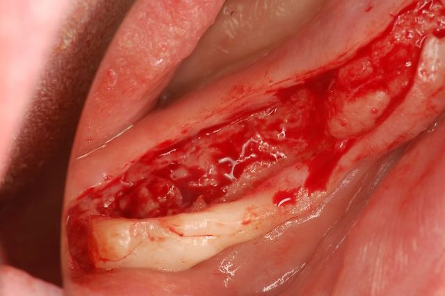 インプラント手術外科剥離時