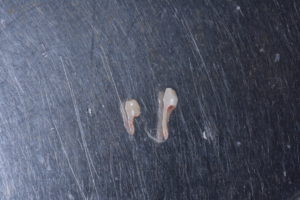 乳歯歯根吸収不全