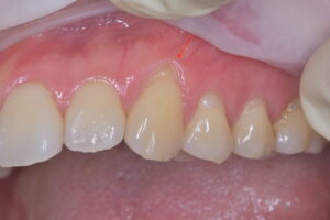 歯肉退縮手術前